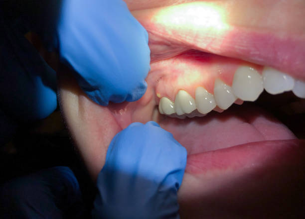 Best Broken or Cracked Tooth Emergency Dentist in Ramblewood, NJ